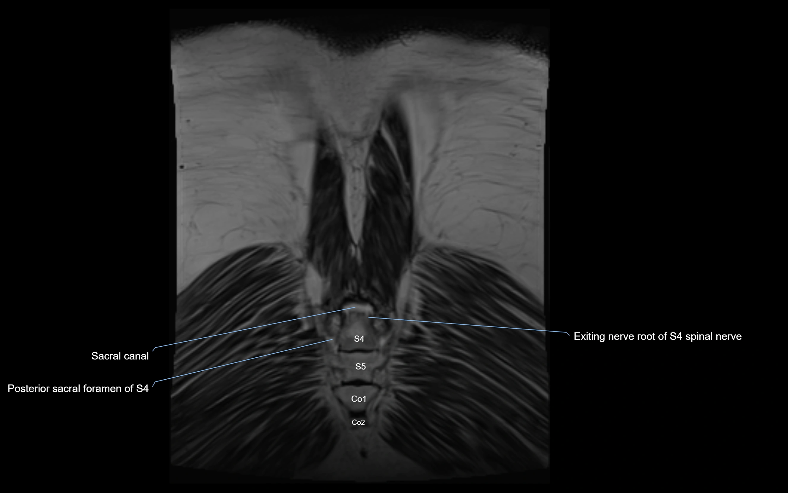 MR lumbosacral plexus cross sectional anatomy 3T  radiology  image-img-09001-00082.webp